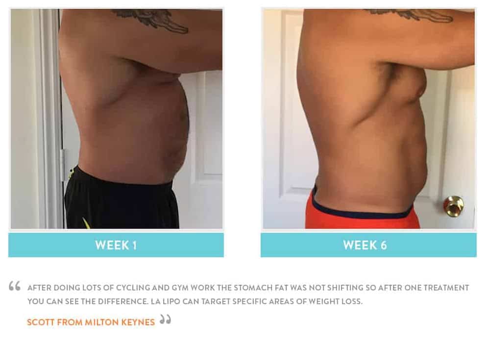 Before & After Stomach Fat Uxbridge