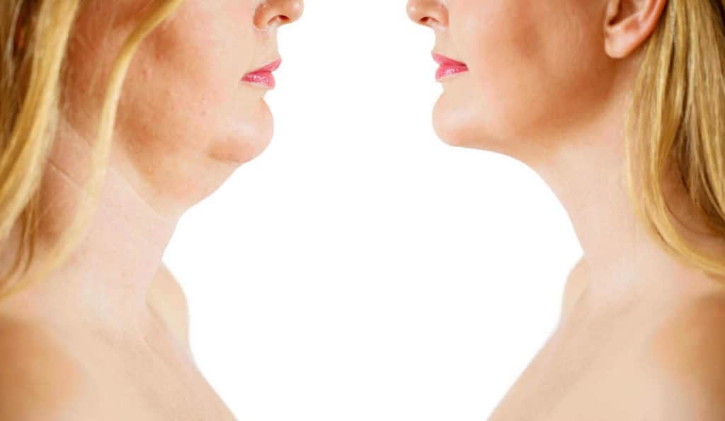 Double Chin treatment Uxbridge before and after results