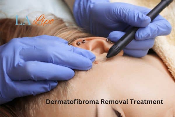 Dermatofibroma Removal Treatment Uxbridge