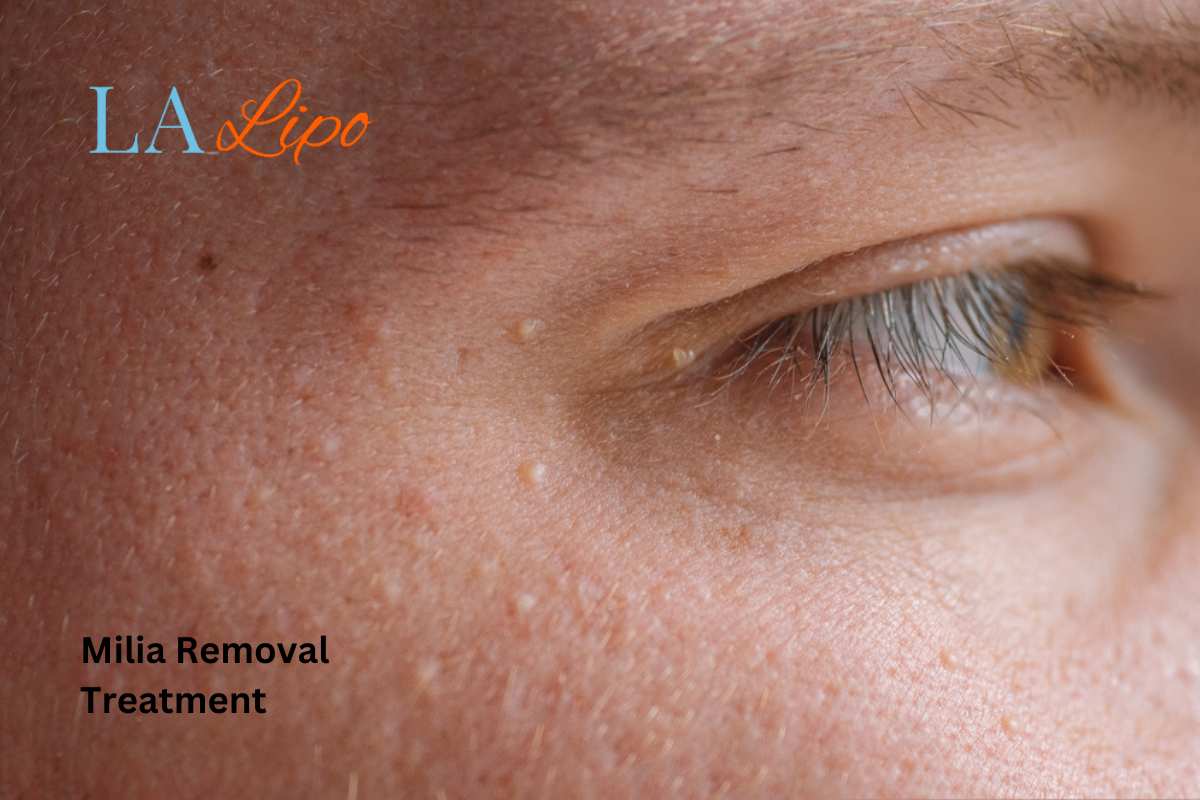 Cryopen Milia Removal: Is It the Easiest and Safest Option Uxbridge?