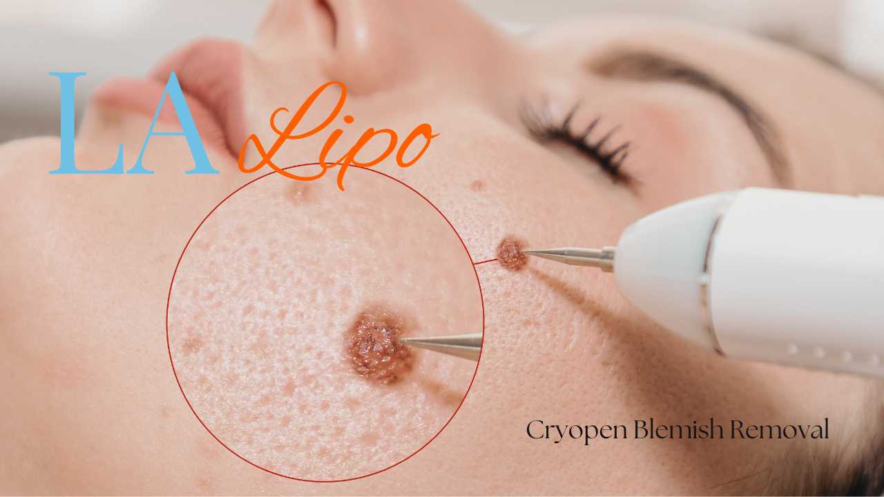 cryopen blemish removal Uxbridge Contact our team today!