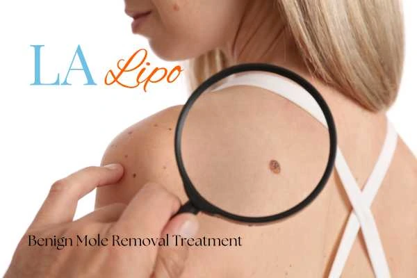 Woman having her inspection of blemish before mole removal Uxbridge