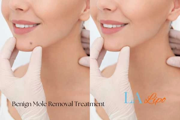 Before and after mole removal Uxbridge treatment
