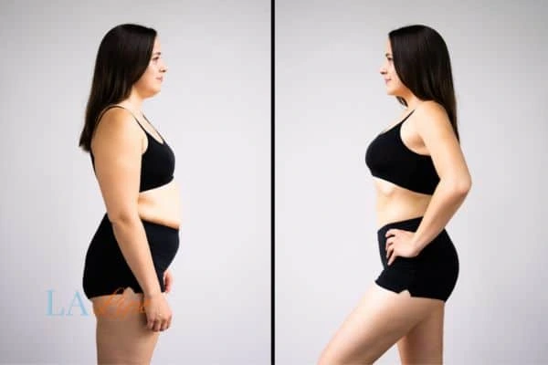 LA-EMS Body Sculpting Uxbridge results before and after of womans results on body toning.
