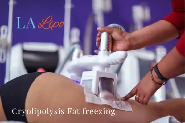 women getting fat freezing Uxbridge