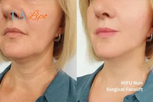 hi-fu for wrinkles Uxbridge before and after results