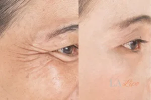 Before and after results of woman - HI-fu wrinkles reduction treatment Uxbridge