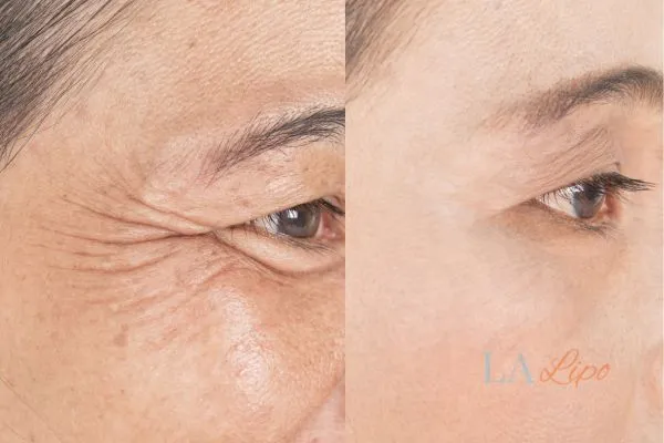 Before and after results of woman - HI-fu wrinkles reduction treatment Uxbridge