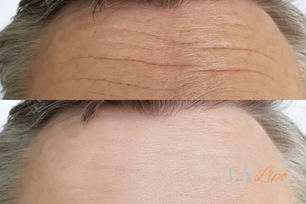 results of HIFU Uxbridge on mans forehead to help reduce lines and wrinkles