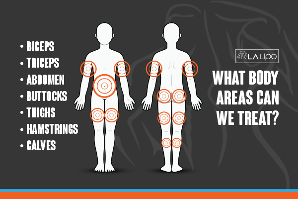Graphic to show areas you can have LA-EMS Body Sculpting Uxbridge treatment.
