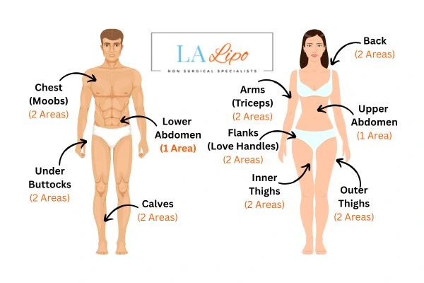 LA LIPO Cryolipolysis Areas Uxbridge