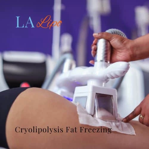 fat freezing - Cryolipolysis Uxbridge
