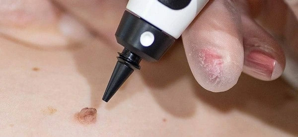skin tag removal using cryopen Uxbridge