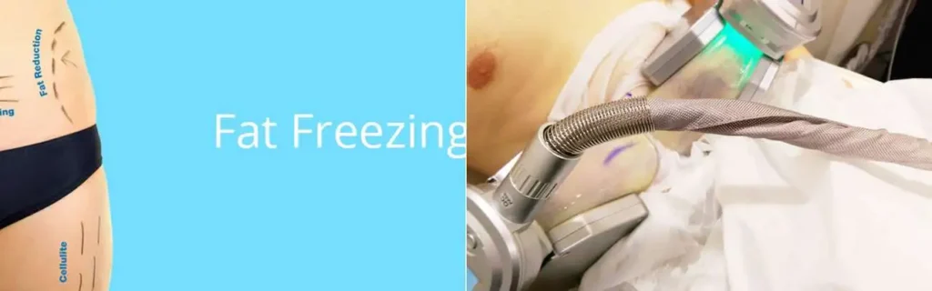 Fat freezing Uxbridge on multiple areas of the body