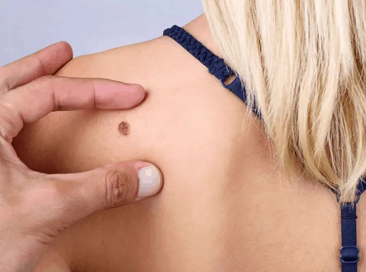 woman having mole removal Uxbridge consultation before treatment.