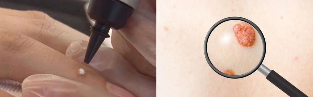 Person getting moles removed with cryopen Uxbridge