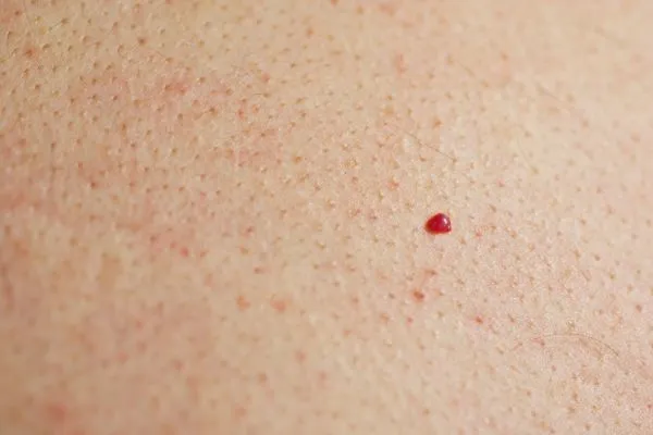 close up of a cherry angioma Uxbridge