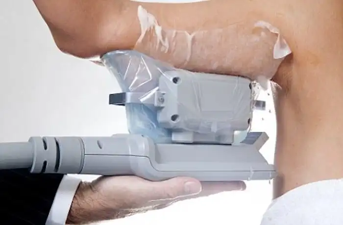 Picture of fat freezing Uxbridge on the upper arms.