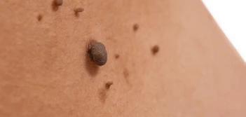 image of a skin tag Uxbridge