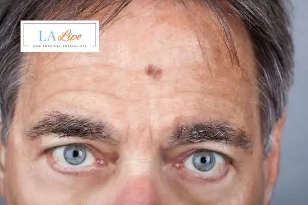 Solar Lentigo Removal Uxbridge image of man with mark on his forehead