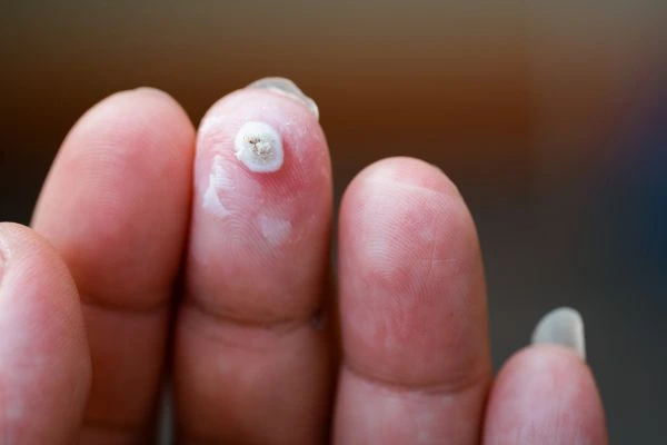 wart on person finger - cryotherapy to treat from LA LIPO Uxbridge