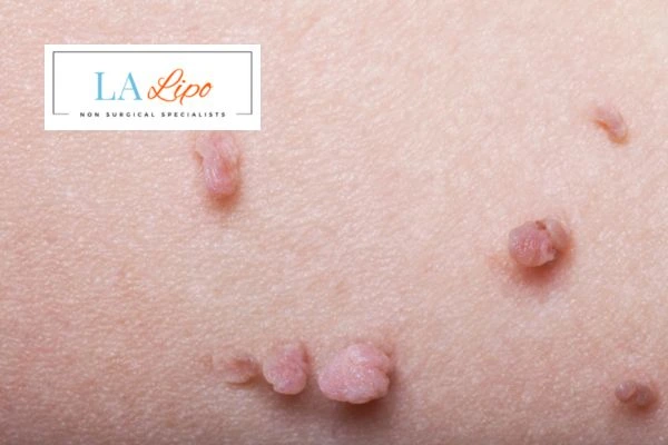 Does cryopen skin tag removal Uxbridge hurt? Find out now call our team today!
