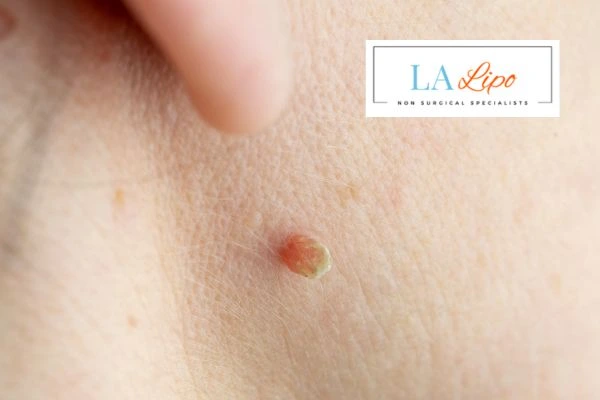 Book skin tag removal Uxbridge today speak to our team now!