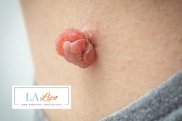 Interested in skin tag removal Uxbridge? Concerned about the pain? Find out more today!