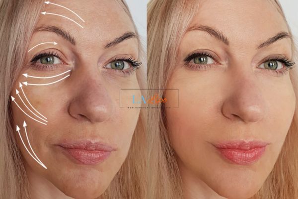 Morpheus 8 results Uxbridge face lift.