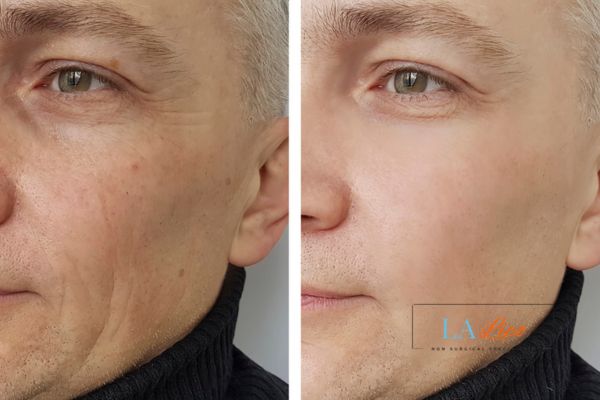 See the amazing results of Morpheus8 Treatment Uxbridge!