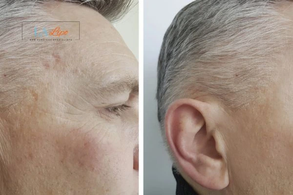 Mens Before & After Morpheus 8 Results Uxbridge