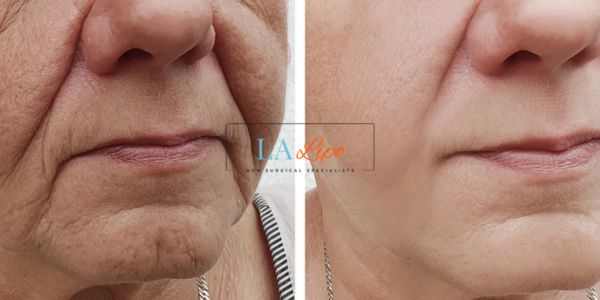 Older lady deeper wrinkle reduction - LA LIPO Morpheus 8 Results Uxbridge