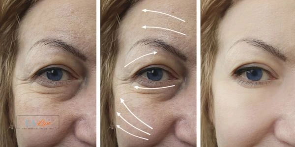 Amazing eye lift Morpheus 8 results Uxbridge