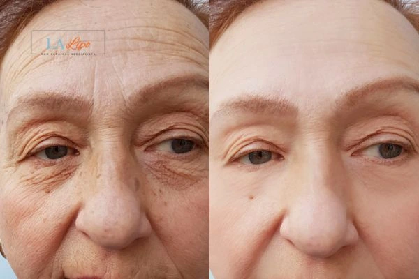 The powerful benefits of Morpheus8 Treatment Uxbridge - Call Our team today!