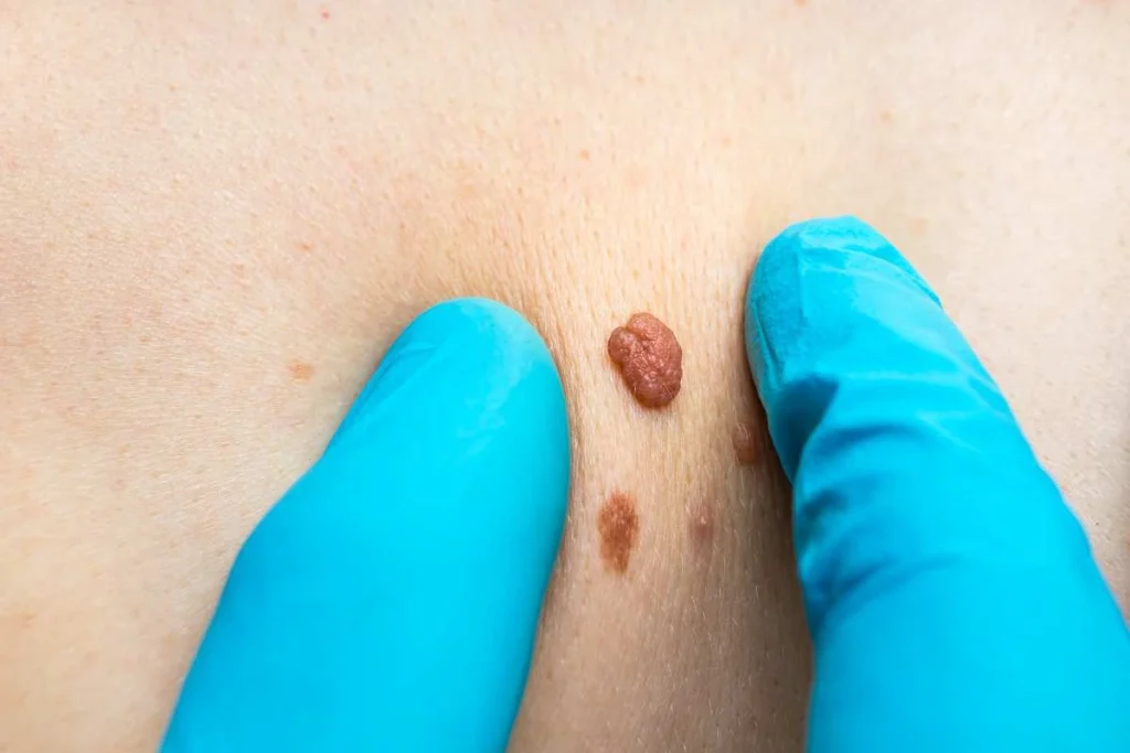 LA LIPO Cryopen Lesion Removal Prices Uxbridge