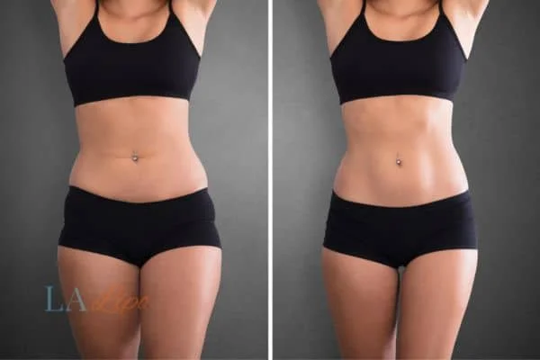 before and after results of non-surgical treatment to help a woman's body image and mental health Uxbridge