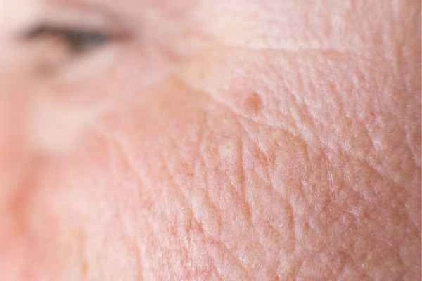 close up picture of a woman's face showing an age spot Uxbridge