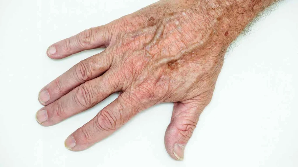 Male hand showing age spot Uxbridge
