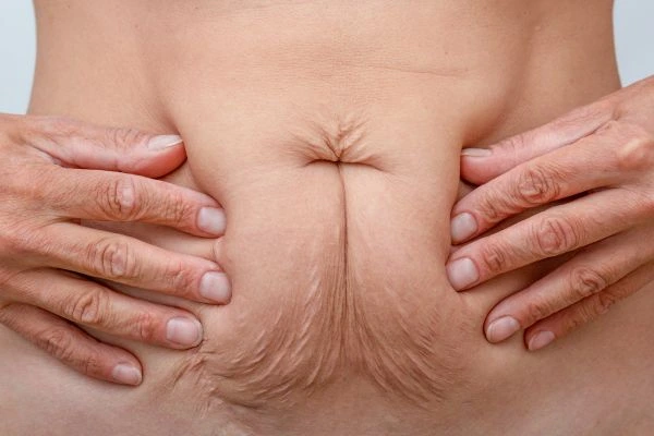 Image of a woman's stomach with loose skin - example of skin tightening Uxbridge options