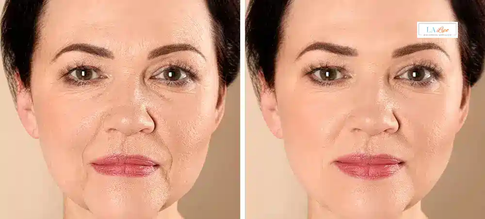How Long Does It Take to See Results and How Long Do They Last Uxbridge?