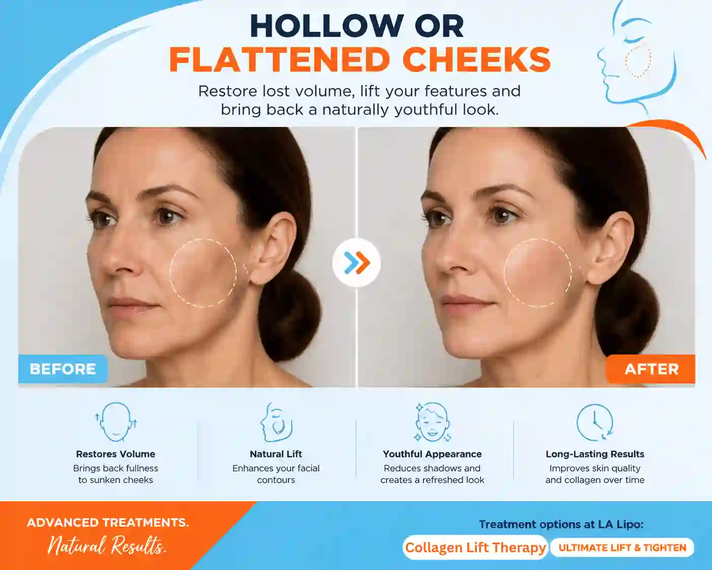 Sign #4: Hollow or Flattened Cheeks Uxbridge