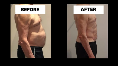 What Symptoms Can Diastasis Recti Cause in Men? Weak Core, Back Pain and Poor Posture Uxbridge